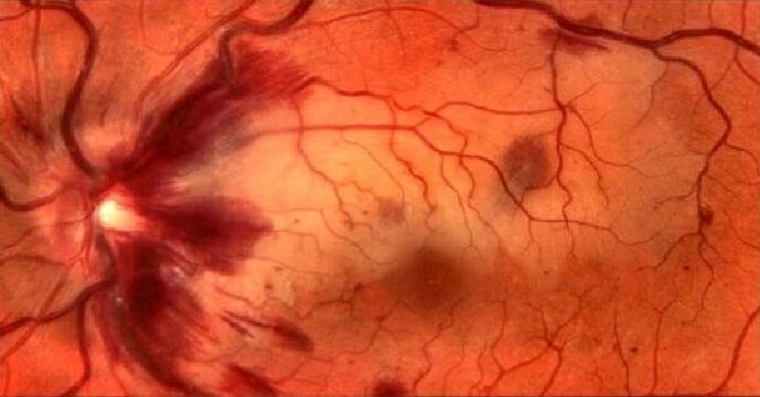 vasi sanguigni della retina e ripristino della visione